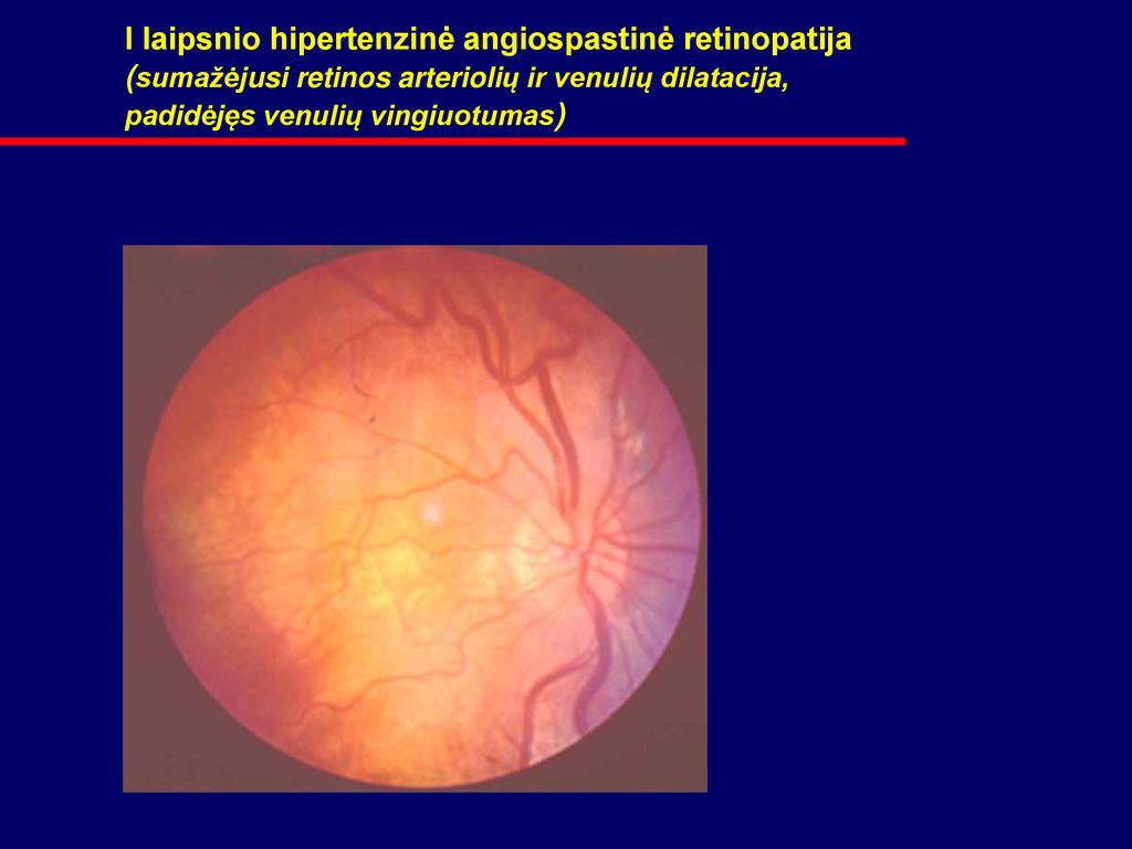 retinopatija, hipertenzija